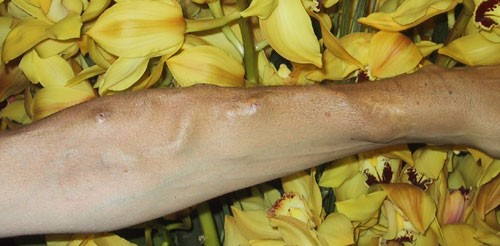 AV fistula access photograph